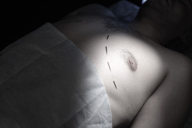 best gynaecomastia treatment in south mumbai