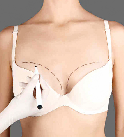 Breast Lift